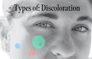 discolorationblogheader2560-x-1652-px-620x400.png